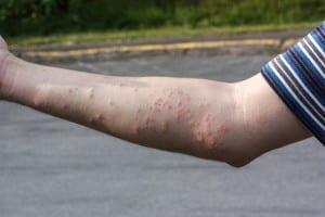 As mordidas de bed bugs podem causar irritação e erupções na pele