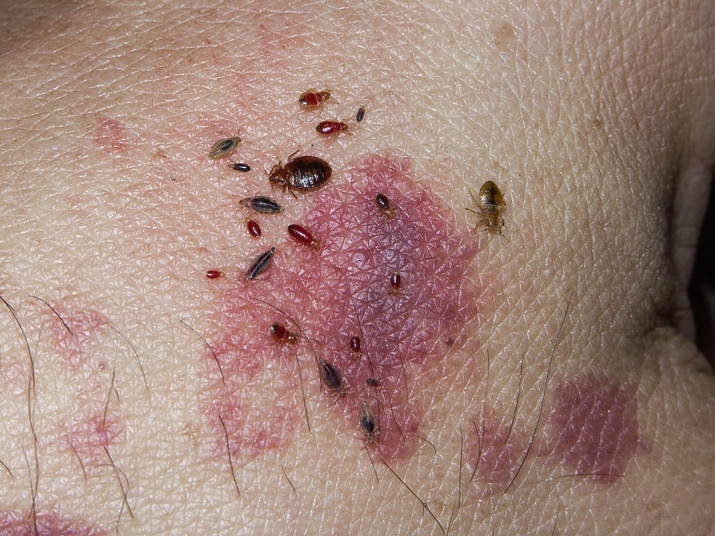 Estrago causado na pele por causa de um bed bug
